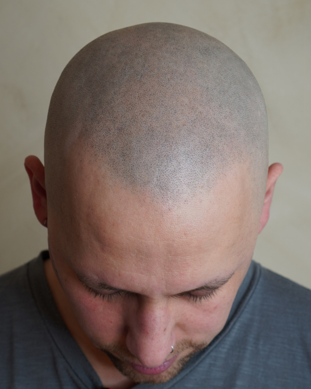 Resultado de micropigmentación capilar — Rafael Scalp Artist